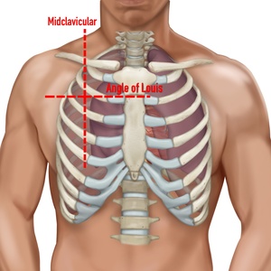 Repères pour décompression à l’aiguille pneumothorax vue frontale 