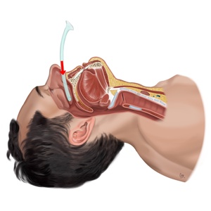 Canule nasopharyngée insertion 